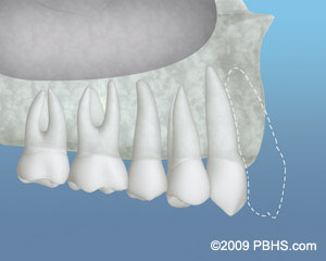 The image shows a dental implant with multiple teeth attached, positioned against a blue background.