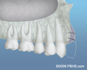 The image shows a 3D rendering of a human upper dental arch with teeth, including a set of dentures, against a blue background, with annotations pointing to specific areas.