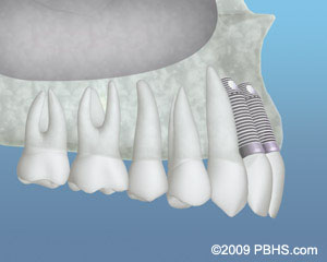 The image shows a close-up view of a dental implant with a metal abutment and a screwed into a tooth root, which appears to be part of a dental prosthesis.