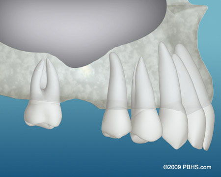 The image shows a close-up view of several dental implants with a partial denture in place, set against a blue background.