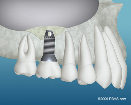 The image depicts a 3D rendering of a dental implant system with various components, including a screw, abutment, and crown, shown against a background that appears to be an X-ray or medical imaging device.