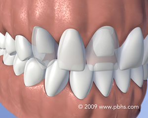 The image shows a close-up view of a person s teeth with white fillings, set against a plain background.
