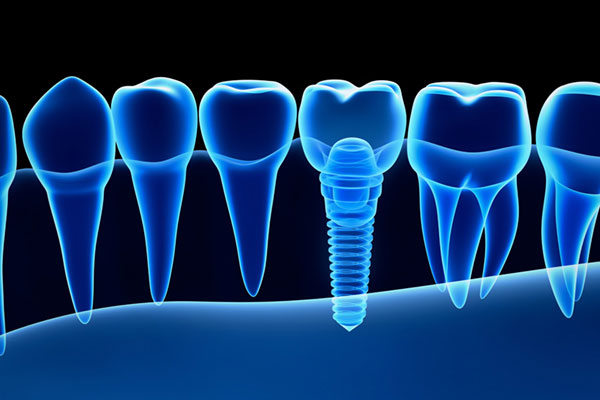 The image shows a collection of tooth implants with a single screw visible at the top center, set against a dark background.