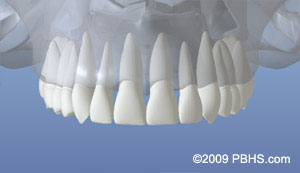 The image shows a 3D model of a human upper denture with teeth and gums, displayed against a blue background.