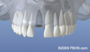 The image shows a close-up view of a set of upper dental implants with visible screws and a blue background, which appears to be a medical or dental setting.