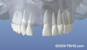 The image shows a close-up view of a human mouth with multiple teeth, including an upper denture with visible clasps, against a blue background.