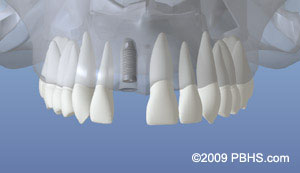 The image shows a 3D model of a human mouth with teeth and gums, which appears to be a dental implant demonstration piece.