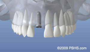 The image displays a 3D model of a dental implant with multiple teeth attached, set against a blue background, designed for educational or demonstration purposes.
