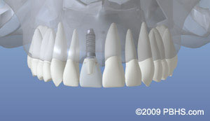 The image shows a three-dimensional model or representation of a human mouth with multiple teeth, including front incisors and canine teeth, set against a blue background.