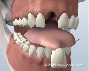 The image shows a 3D rendering of an open human mouth with teeth and gums visible, set against a plain background.