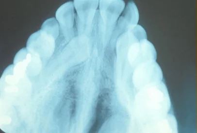 An X-ray image showing an upper dental arch with multiple teeth.