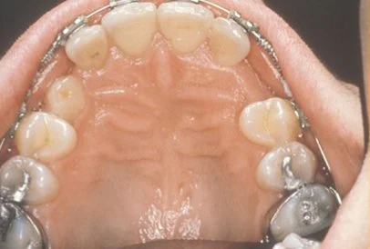 The image shows a close-up view of an open mouth with visible teeth, gums, and dental implants or prosthetics, along with some metallic components that appear to be part of orthodontic or oral surgical appliances.