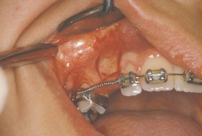 The image shows a mouth with a tooth being removed, featuring a visible root canal procedure with tools inside the tooth socket.