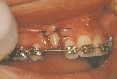The image shows a close-up view of a person s mouth with visible dental work, including braces and possibly a tooth extraction site, with an insect inside the oral cavity.