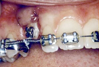 The image shows a close-up view of a person s mouth with a dental implant, featuring visible screws, abutments, and a metal framework, suggesting that the implant is either being installed or removed.