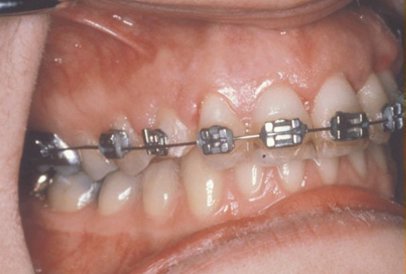 A close-up view of a person s mouth with braces and teeth, capturing a smile.
