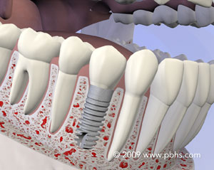 The image shows a close-up view of a human mouth with teeth and gums, featuring a dental implant screwed into the jawbone, and a surgical drill visible in the lower left corner, indicating a dental implantation procedure.