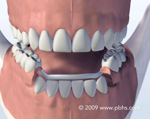 The image shows a 3D rendering of an open human mouth with teeth and gums visible, set against a neutral background.
