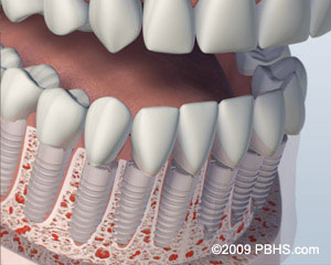 The image shows a detailed 3D rendering of a human teeth implantation procedure with a focus on the dental implants and surrounding structures, such as the gums and bone tissue.