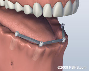 The image shows a 3D rendering of a human mouth with an implant or dental prosthesis in place, featuring a metal bracket attached to the upper front teeth.