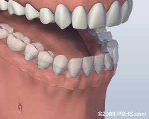 The image displays a three-dimensional rendering of an open human mouth with visible teeth and gums, set against a plain background.