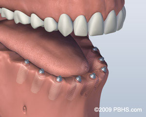 The image shows a close-up view of a human mouth with teeth and gums, highlighting dental implants and possibly other dental work.