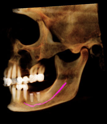 The image displays a medical X-ray showing an upper dental arch with a partial denture and a single tooth implant, highlighting the implant s placement within the jawbone.