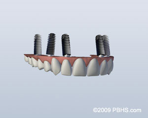The image shows a 3D rendering of a dental implant fixture with multiple screw-like components, likely used for securing an artificial tooth within a dental implant system.