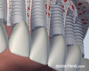 The image shows a close-up view of a person s teeth with a focus on the dental implant structure, which includes screws and abutments, set against a background that appears to be a medical or dental setting.